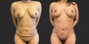 Abdominoplasty + Bilateral Mastopexy  #019, before and after photo
