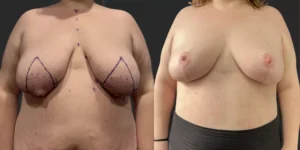 Bilateral Reduction and Lipo of Lateral Breasts #008, before and after photo