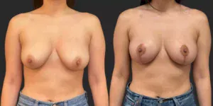 Mastopexy  #023, before and after photo