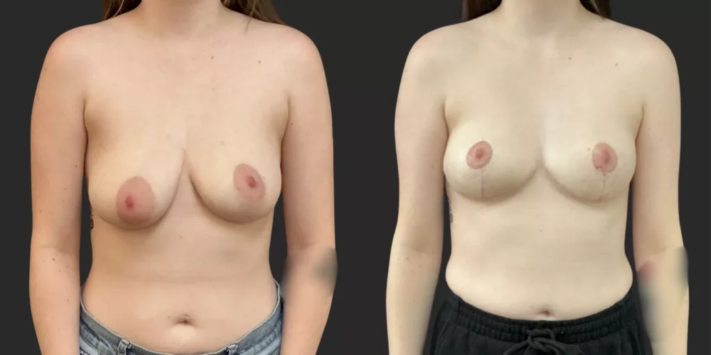 Mastopexy  #021, before and after photo