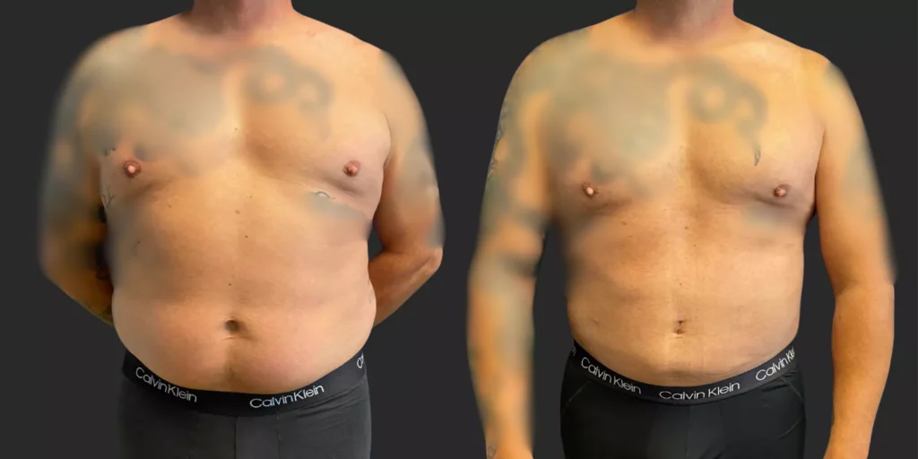 360 Lipo and Gynecomastia Reduction #005, before and after photo