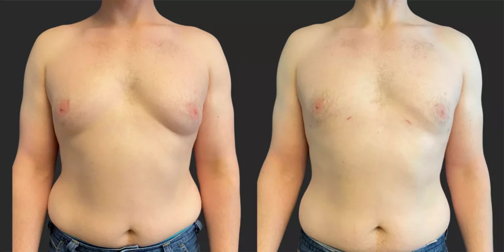 Gynecomastia Reduction #006, before and after photo
