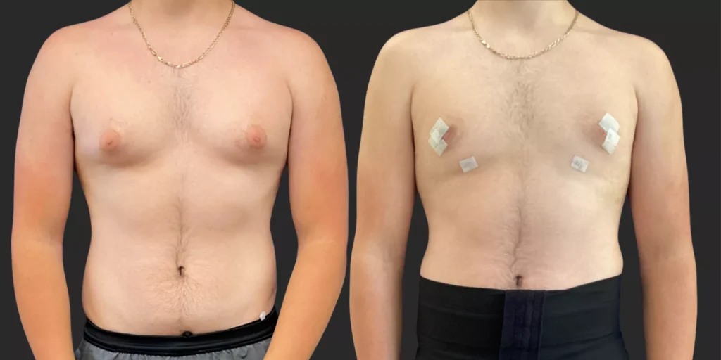 Gynecomastia Reduction #002, before and after photo