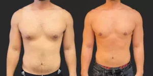 Gynecomastia Reduction with Lipo #003, before and after photo