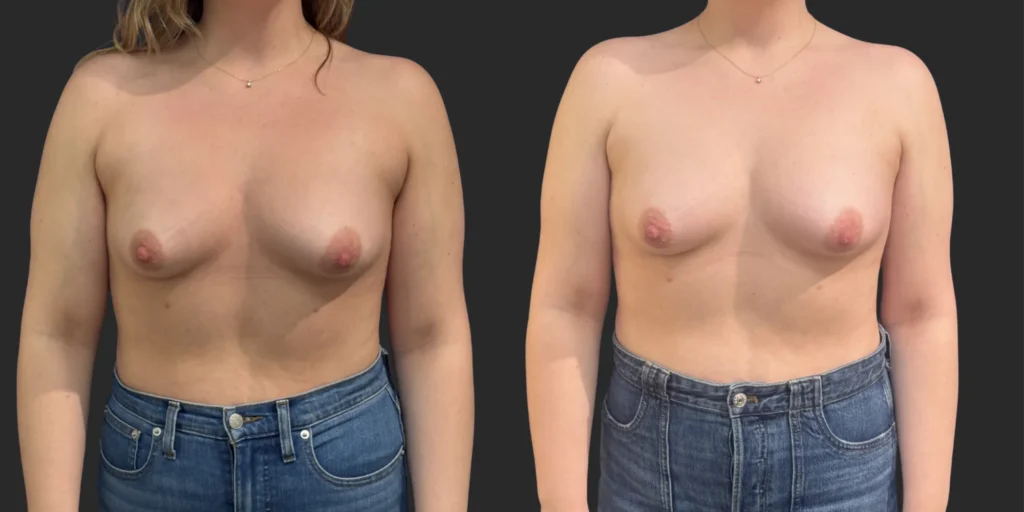 Liposuction of Arms, Back/Front Bra Roll #030, before and after photo