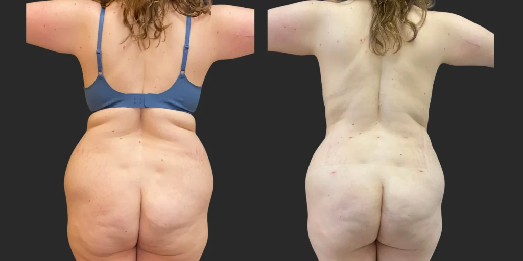 Liposuction of Hips/Waist #031, before and after photo, view 2