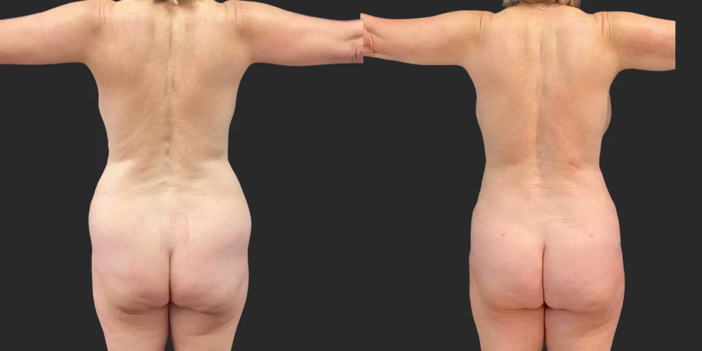 Liposuction of Upper/Lower Abdomen #032, before and after photo, view 2