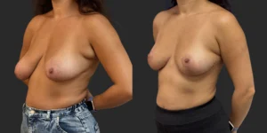 Mastopexy  #027, before and after photo, view 2