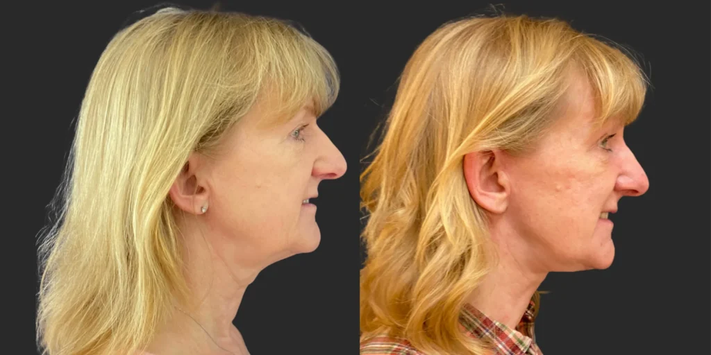 Cameo 3 Facelift #014, before and after photo, view 2