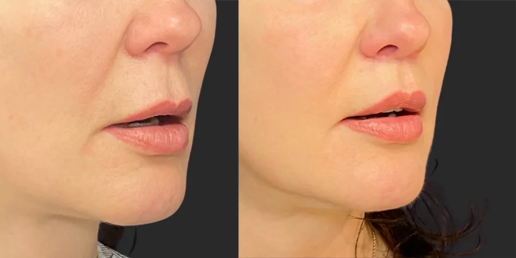 Lip Lift #016, before and after photo, view 2