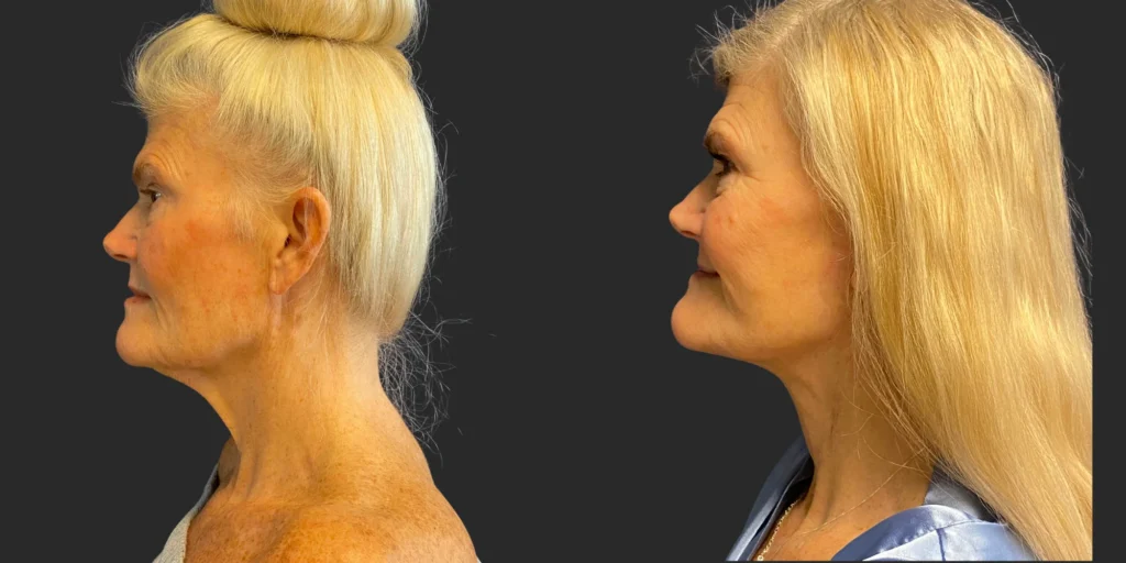 Cameo 3 Facelift #017, before and after photo, view 2