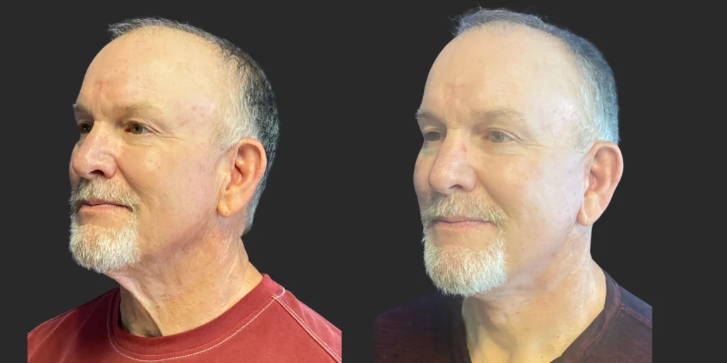 Cameo 3 Facelift #020, before and after photo, view 2