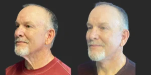 Cameo 3 Facelift #020, before and after photo, view 2