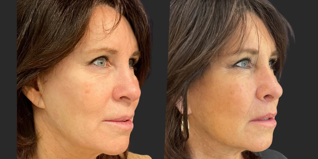 Lip Lift #021, before and after photo, view 2