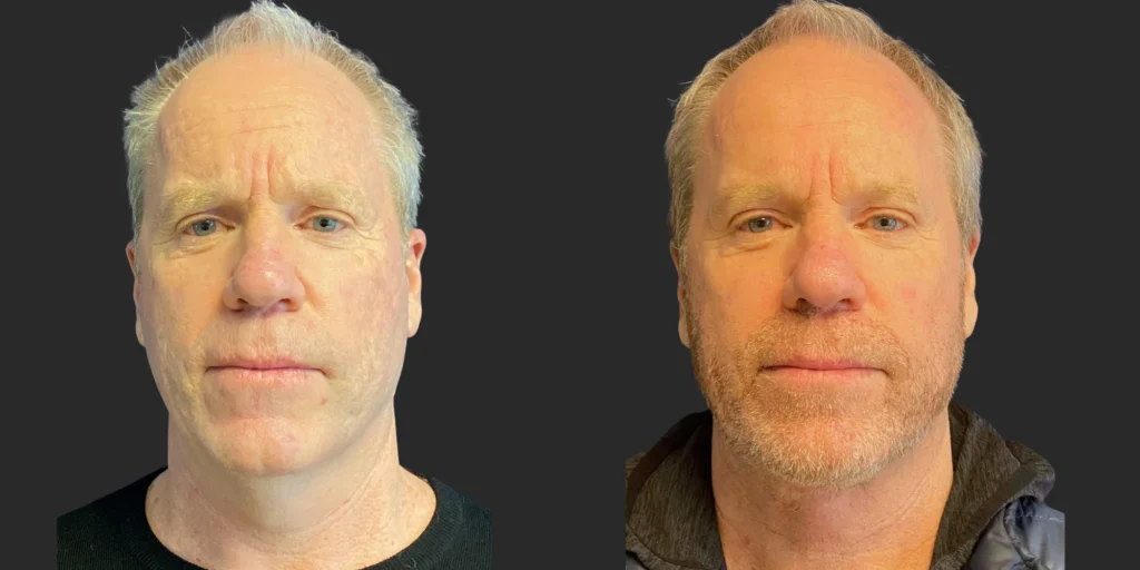 Cameo 2 Necklift #022, before and after photo