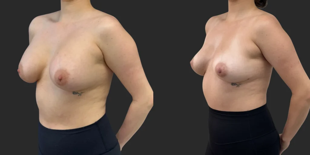 Implant Removal #010, before and after photo, view 2
