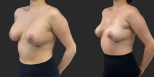 Implant Removal #010, before and after photo, view 2