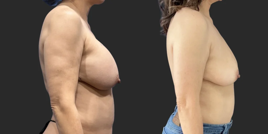 Bilateral Submuscular Implant Removal #011, before and after photo, view 2