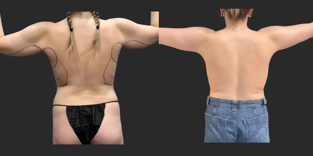 Liposuction of Arms, Back/Front Bra Roll #030, before and after photo, view 2