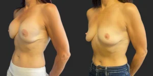 Bilateral Implant Removal #014, before and after photo, view 2