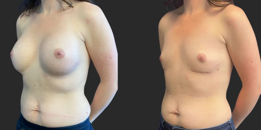 Implant Removal #016, before and after photo