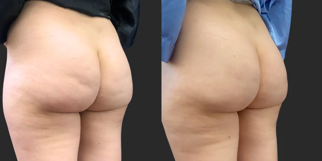 Avéli Cellulite Reduction #004, before and after photo, view 2