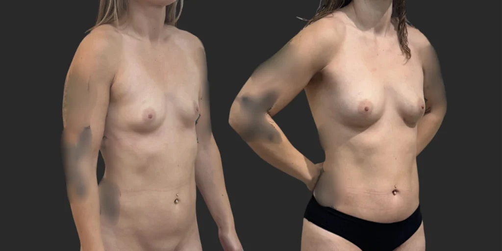 Lipo of Inner/Outer Thighs + Knees with Fat Transfer to Breasts #034, before and after photo, view 2
