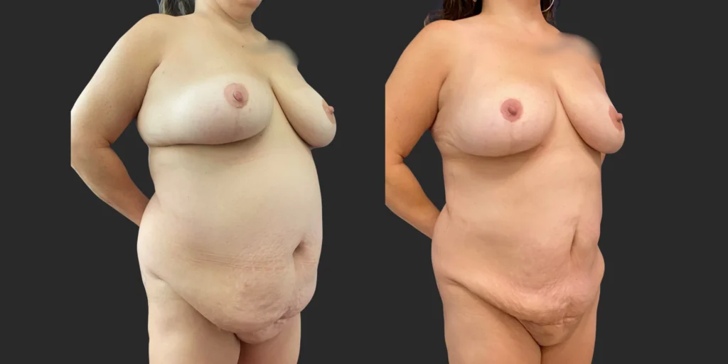 Lipo of Upper/Lower Abdomen, Pubis, Front Bra Roll, Lateral Breasts #035, before and after photo, view 2