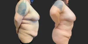 Lipo to Hips/Waist/Back Bra Roll with Fat Transfer to Buttocks #037, before and after photo, view 2