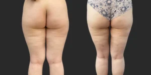 Lipo of Inner/Outer Thighs + Knees #039, before and after photo, view 2