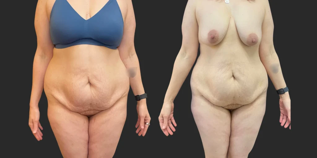 Liposuction of Hips/Waist #031, before and after photo