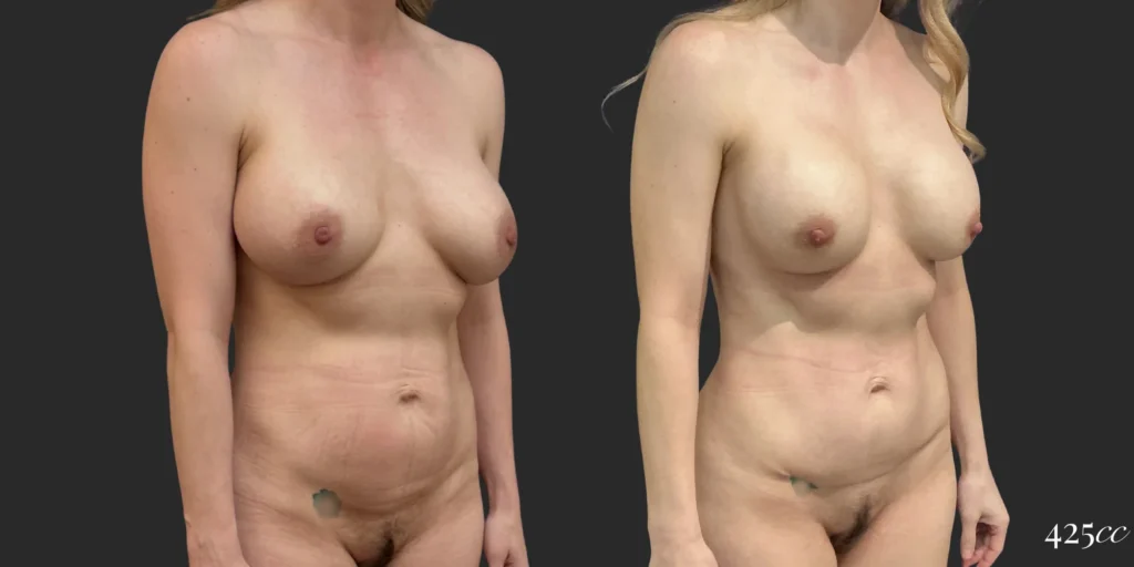 Pocket change and Mini Abdominoplasty #001, before and after photo, view 2
