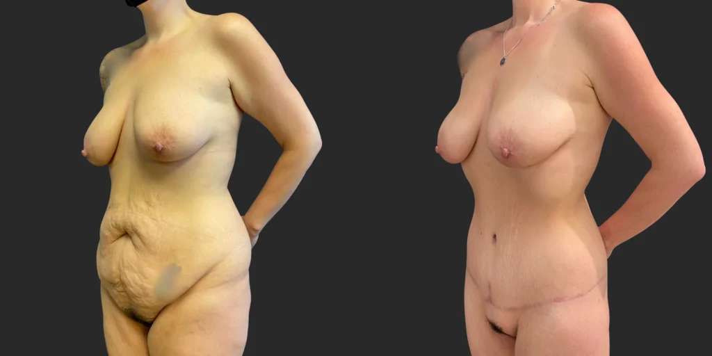 Abdominoplasty and Belt Lipectomy #003, before and after photo, view 2