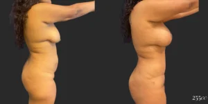 Abdominoplasty with Mastopexy and Breast Augmentation #004, before and after photo, view 3