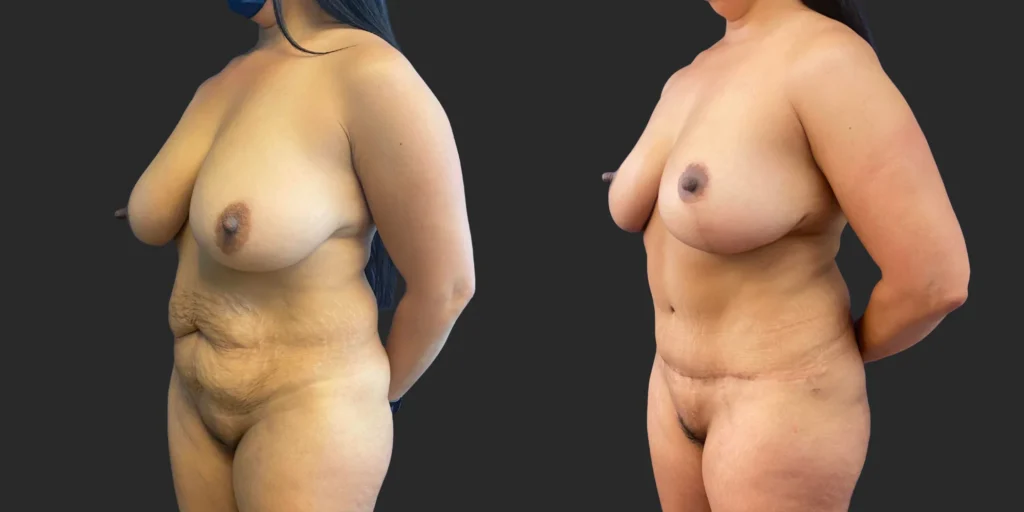 Abdominoplasty and Breast Reduction #005, before and after photo, view 2
