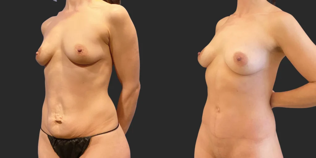 Abdominoplasty with Fleur de Lis #006, before and after photo, view 2