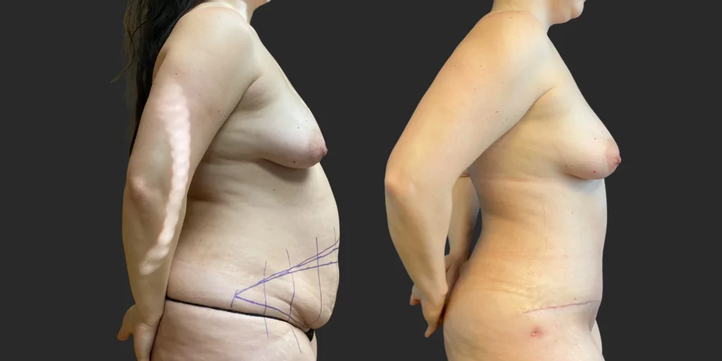Abdominoplasty #007, before and after photo, view 2