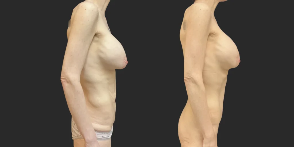 Abdominoplasty #008, before and after photo, view 2