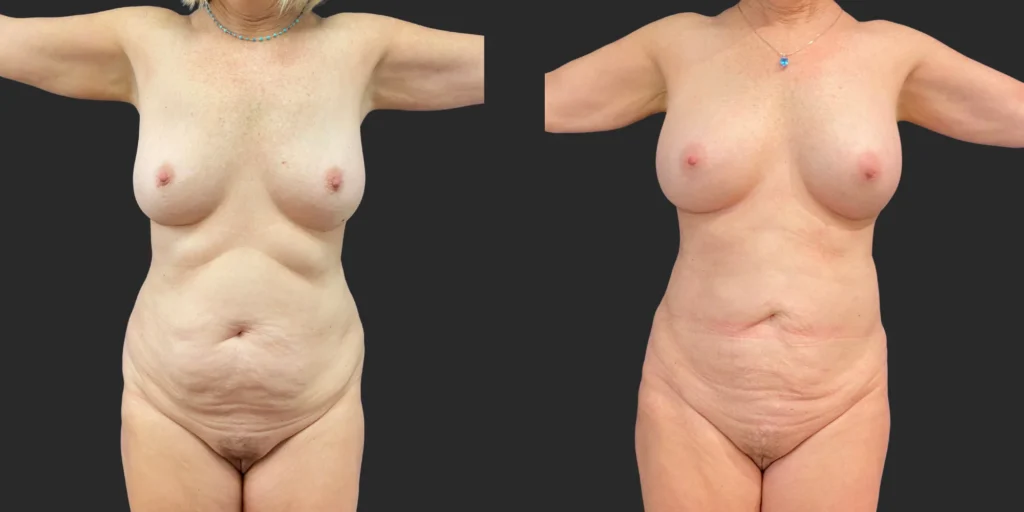 Liposuction of Upper/Lower Abdomen #032, before and after photo