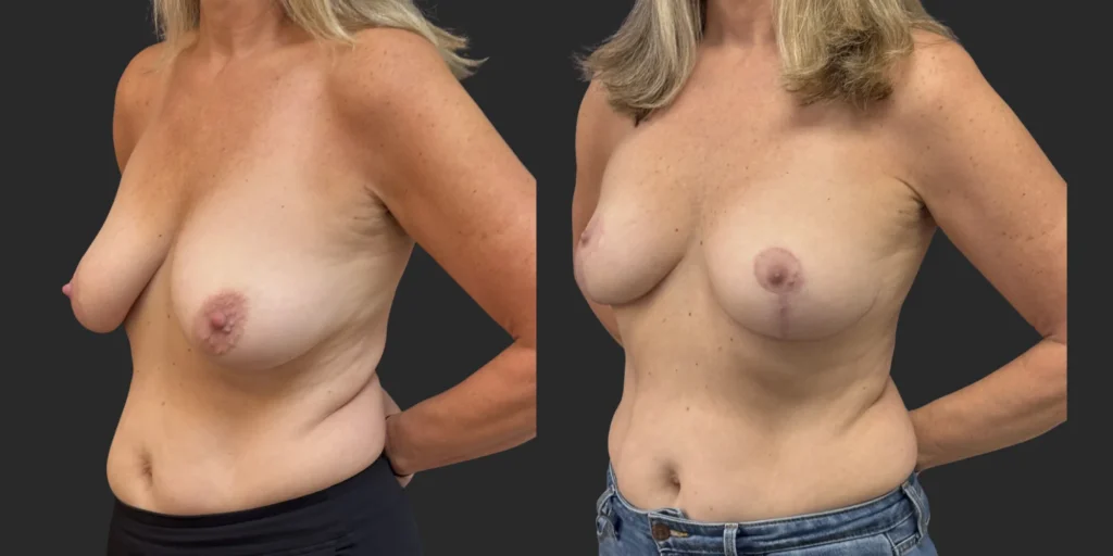 Bilateral Breast Reduction  #011, before and after photo, view 2