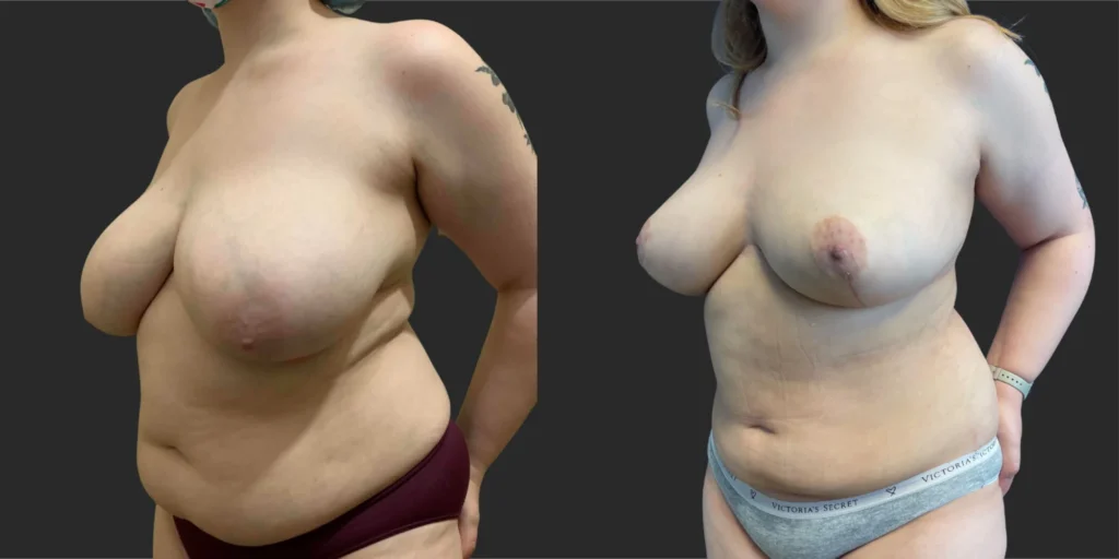 Breast Reduction  #012, before and after photo, view 2