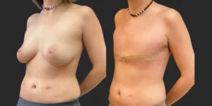 Gender Affirming Surgery #011, before and after photo, view 2