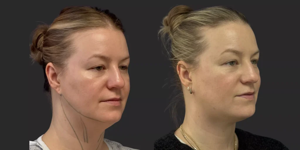 Chin Liposuction #004, before and after photo