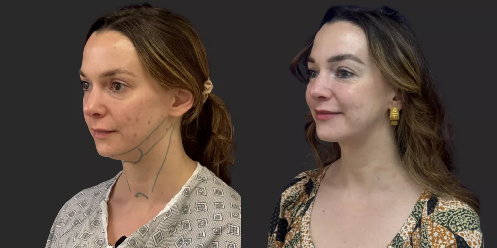 Chin Liposuction #005, before and after photo