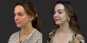 Chin Liposuction #005, before and after photo