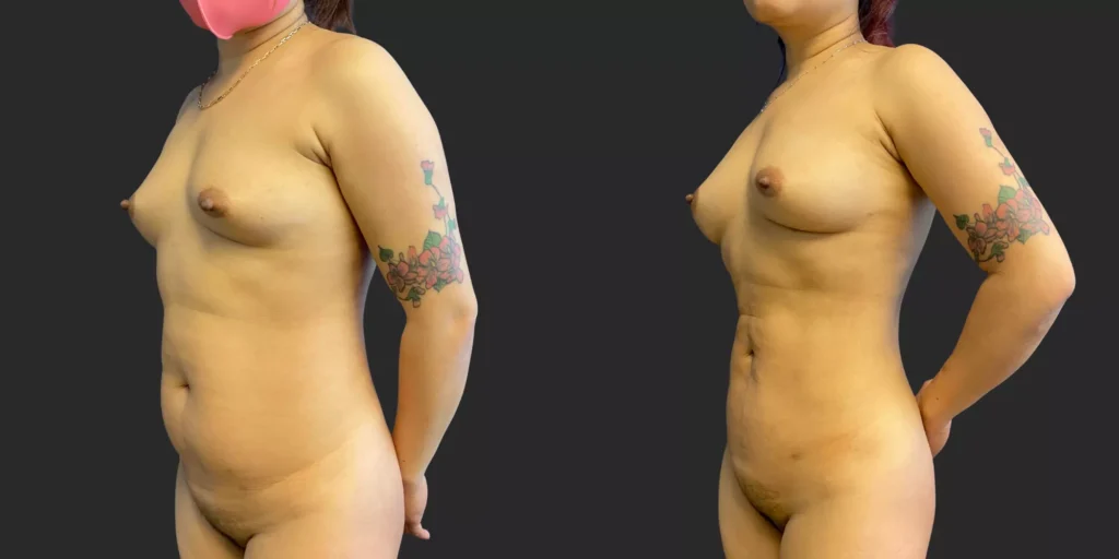 360 LBA plus armpits #033, before and after photo, view 2