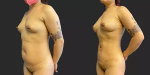 360 LBA plus armpits #033, before and after photo, view 2