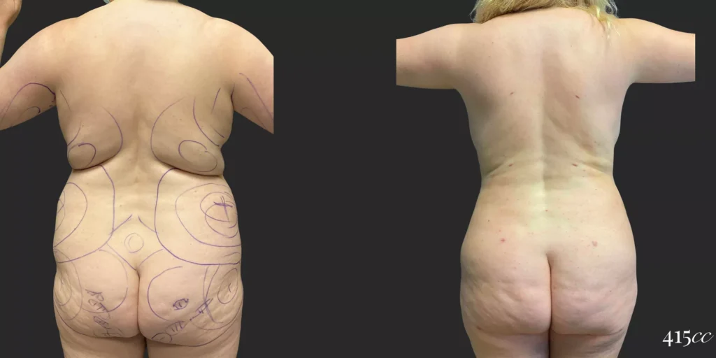 360 BBL plus Liposuction of Upper Arms and Breast Augmentation #034, before and after photo, view 2