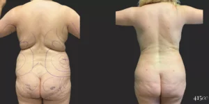 360 BBL plus Liposuction of Upper Arms and Breast Augmentation #034, before and after photo, view 2