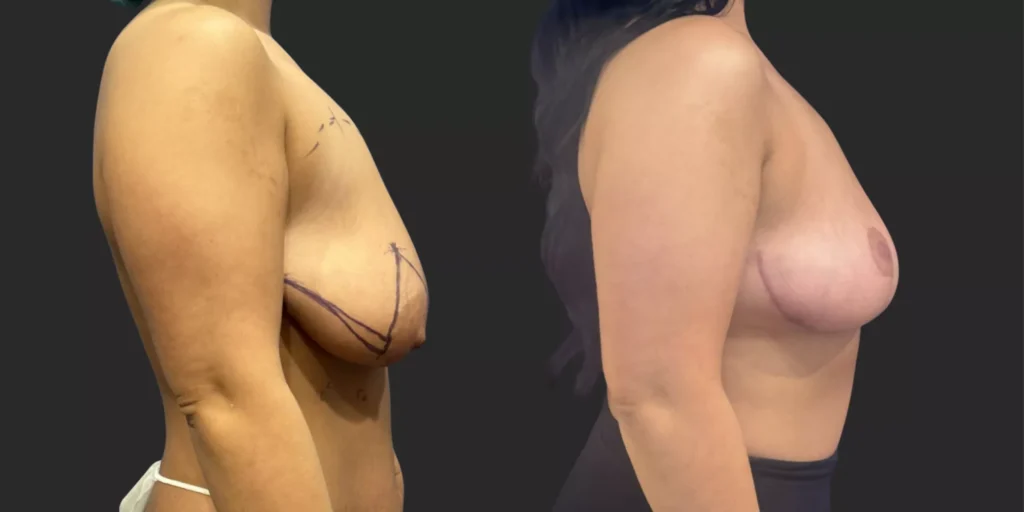 Bilateral Mastopexy  #001, before and after photo, view 2